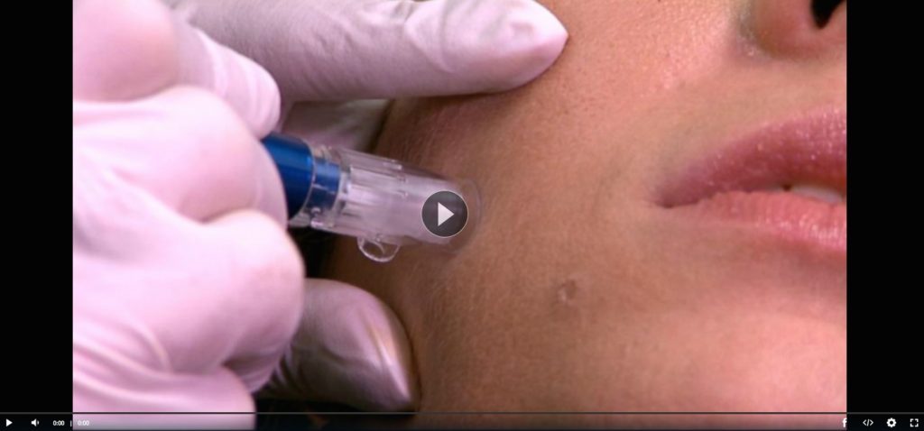 Micro-needling video on abc